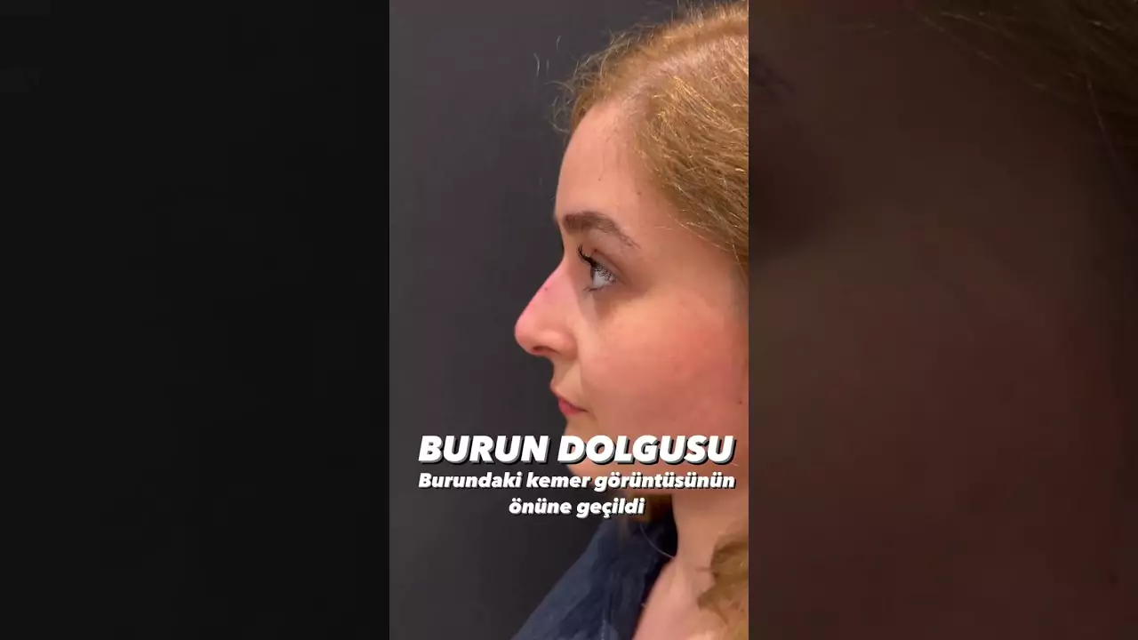 burun dolgusu